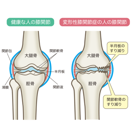 変形性膝関節症①.png