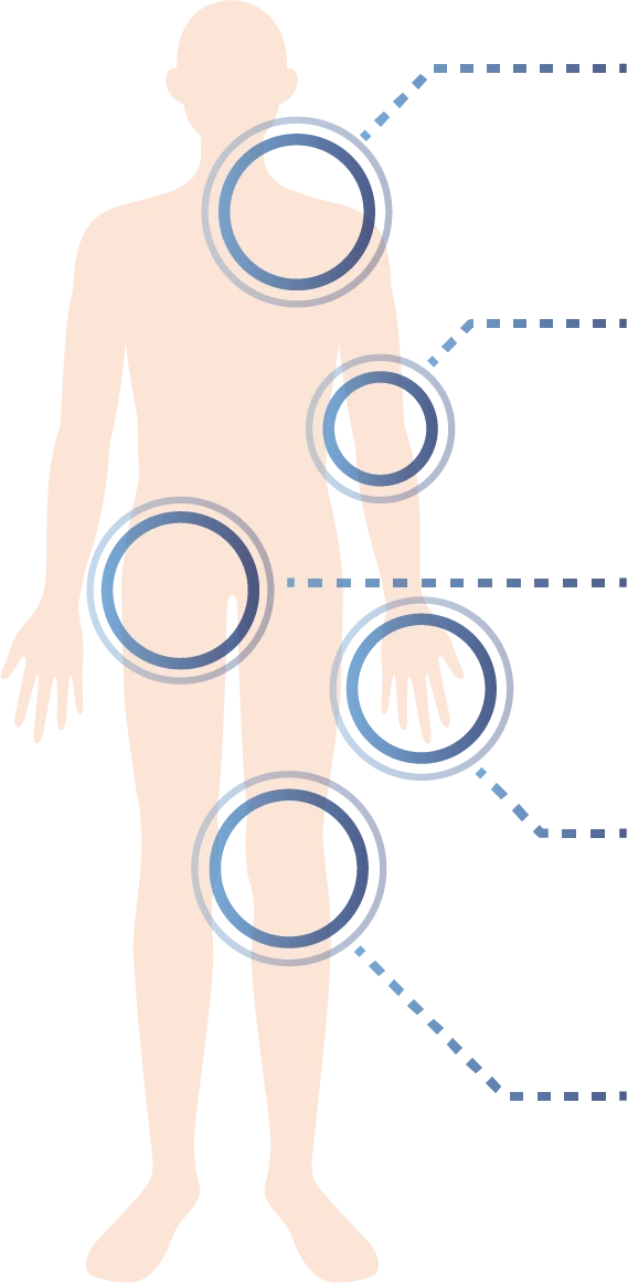 PDF-FD療法の適応部位と疾患